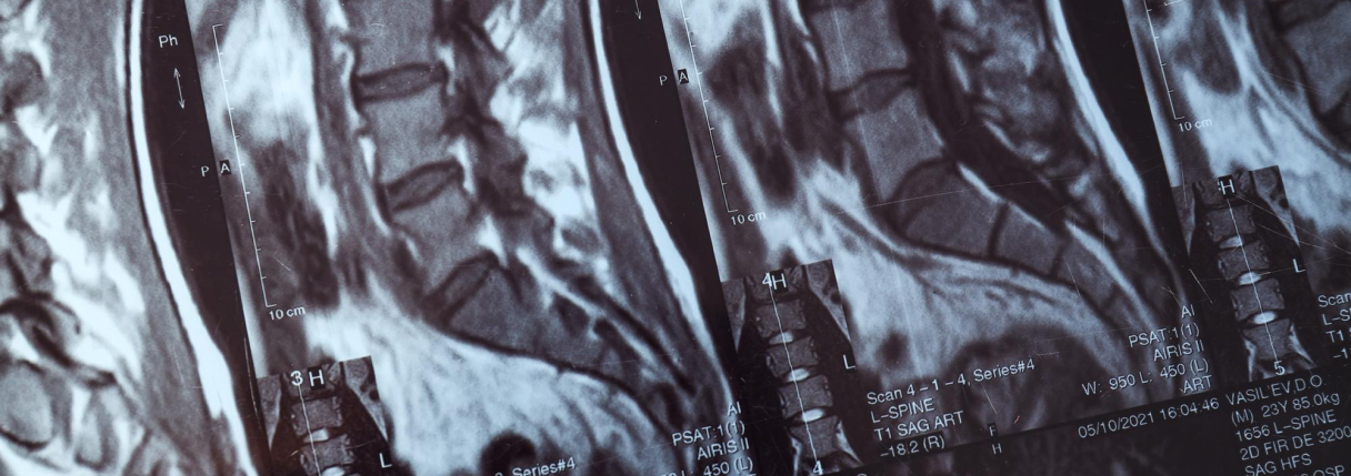 ressonância magnética da coluna